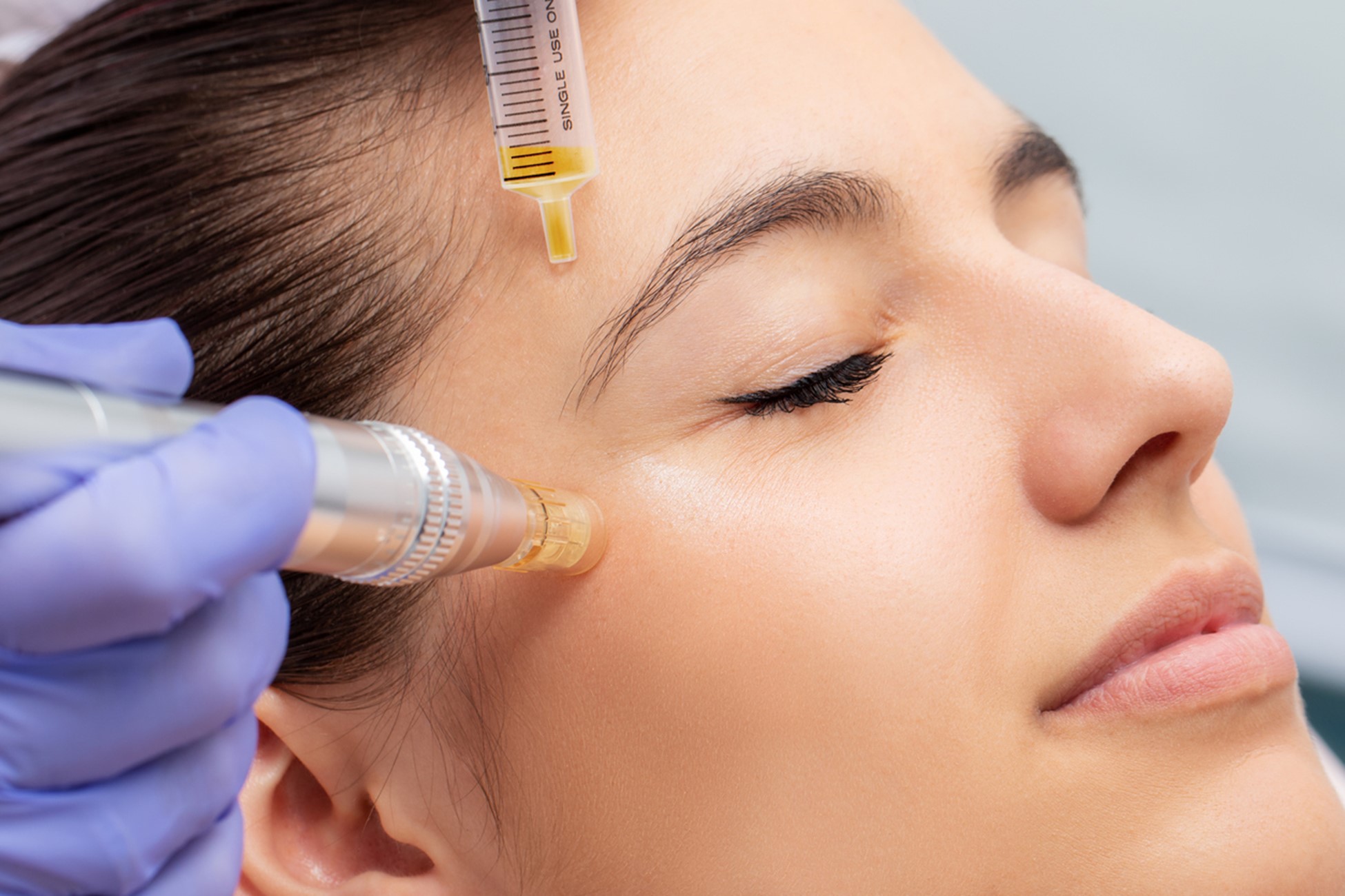 New to Carbon World Health: Platelet Rich Plasma and SkinPen Facial
