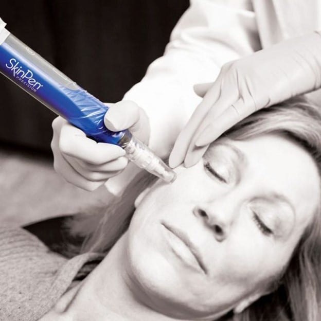 New to Carbon World Health: Platelet Rich Plasma and SkinPen Facial